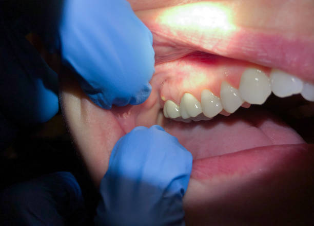 Best Emergency Root Canal Treatment in Payson, UT